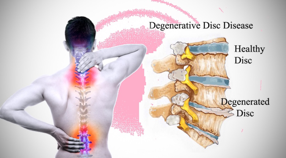 Symptoms -Disc-Desiccation