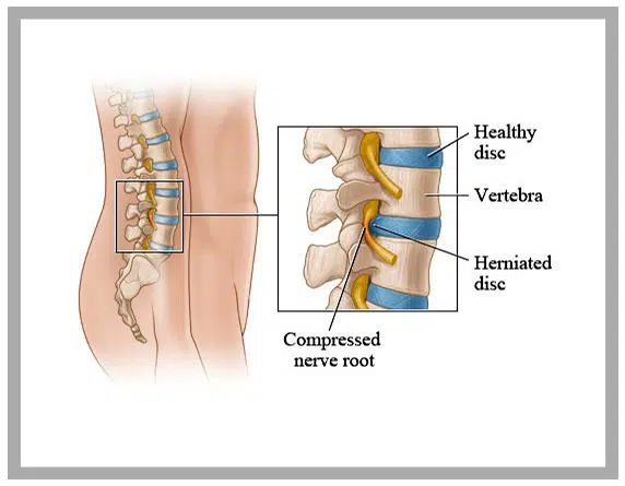 Diagnosis-Disc-Desiccation